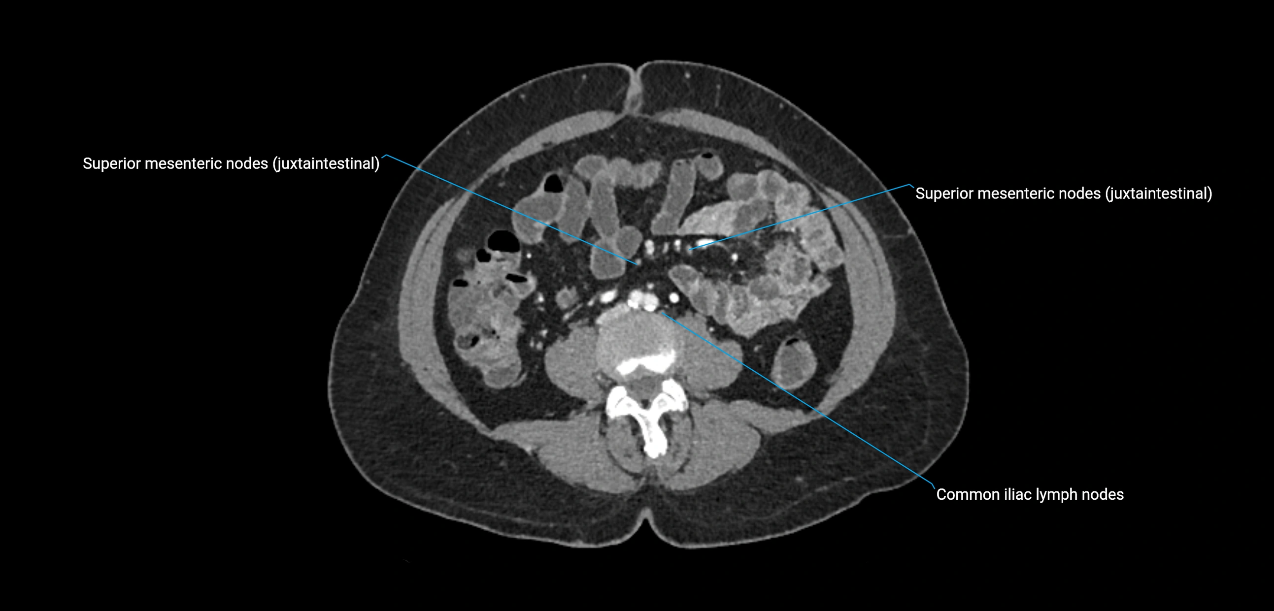 CT ct abdominal lymph nodes  axial cross sectional anatomy  enchanced radiology image -img-00002-00255.webp